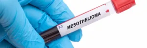 A doctor holding a blood test for mesothelioma, a disease affecting the mesothelial cells