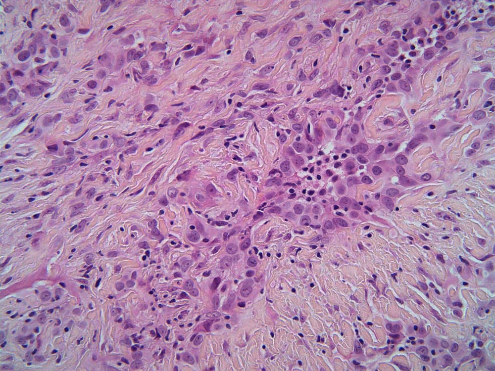 Microscopic view of Mesothelioma cancer cells in lung pleura