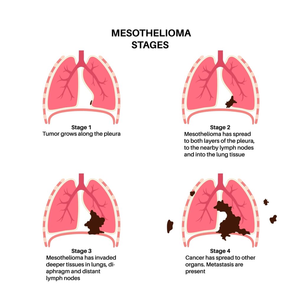 Lung cancer stages, the spread of mesothelioma tumor cells, and illnesses affecting the respiratory system are critical concerns.