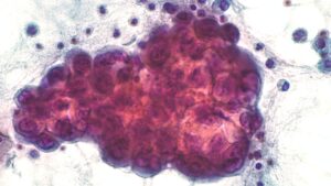 Malignant effusion refers to the presence of pleural fluid associated with lung adenocarcinoma, a subtype of non-small cell lung cancer (carcinoma).