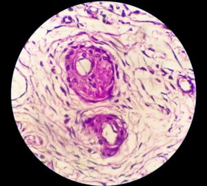 Histology often includes the examination of peritoneal inclusion cysts, paraovarian cysts, hydrosalpinx, and low-grade cystic mesothelioma, which are typically considered in differential diagnoses related to pelvic masses.