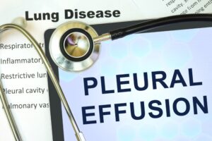 A tablet displaying the words "Pleural Effusion," placed next to a stethoscope, symbolizing the medical diagnosis and examination of this condition.